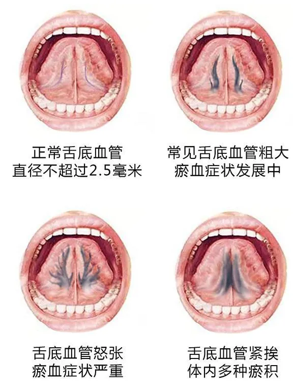 舌头下的青筋代表了什么健康问题? 1.