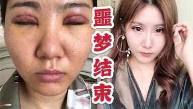 终于不是肿眼泡了！<em class="keyword">双眼皮</em>失败后的三年<em class="keyword">修复</em>之路，关于<em class="keyword">双眼皮</em>的干货！