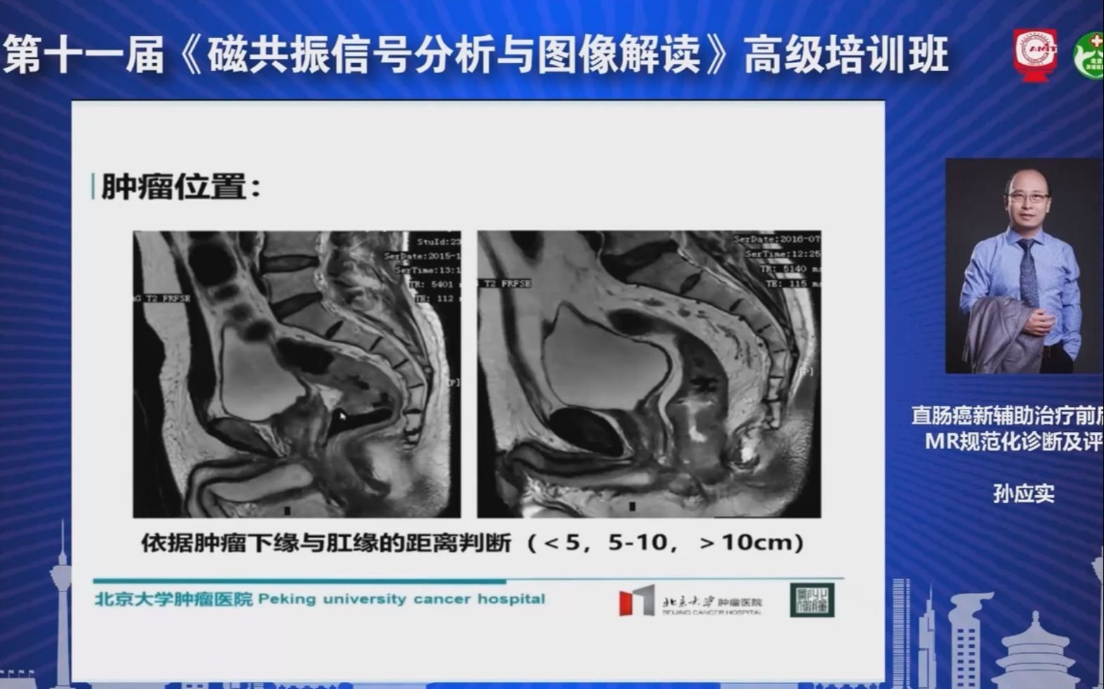 直肠癌MRI图像判读与肿瘤分期