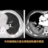 肺基本病变：渗出性病变之实变在CT上的表现，简单易懂