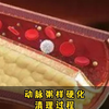 动脉粥样硬化清理过程