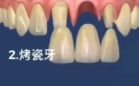 缺失一颗牙，有三种修复方式第一 活动假牙第二 烤瓷牙搭桥第三 种植牙