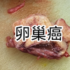 慎入！卵巢癌！一起来看看卵巢囊实性肿物形态吧