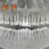 骨黏连智齿没那么可怕 一个视频看会你双侧下颌水平低位阻生骨黏连及上颌两颗智齿快速微创拔除