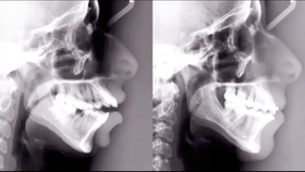 种牙最快多长时间长出来 0709eff285b6465504f3e92e3fa1f18b16e3bf46.jpg@280w_158h_1c_100q.jpg