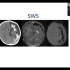 （磁敏感成像，SWI）Susceptibility Weighted Imaging - Joshua P. Nicke