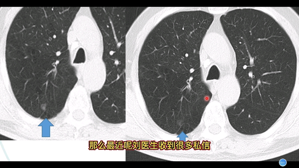 发现肺部磨玻璃结节，一定会恶变吗？放射科医生分享病例