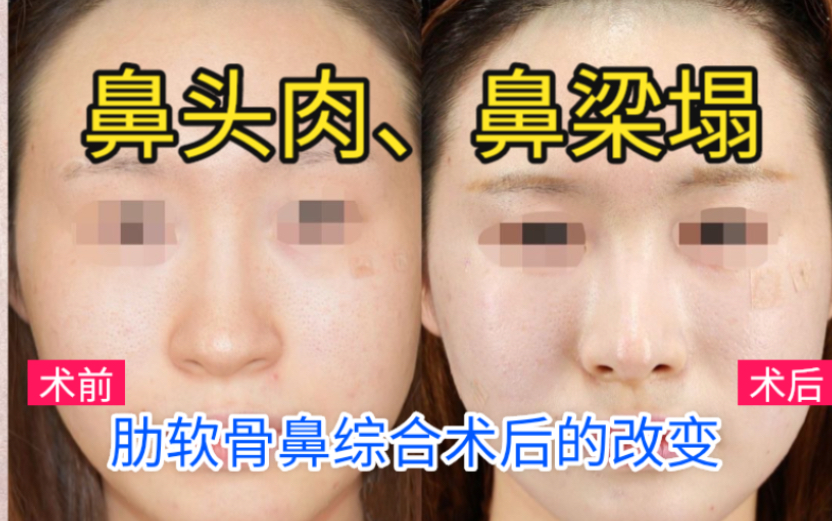 鼻头比较肉鼻梁比较塌的鼻子在女性群体中比较多见这种鼻子基础不差就