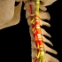 颈椎退化过程中对椎动脉的压迫