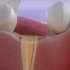 牙齿蛀牙坏掉了怎么办，视频动画还原补牙过程