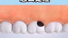 种牙最好什么时间 092d0b15b7dc49447a09f510190c1b476836bed0.jpg@280w_158h_1c_100q.jpg