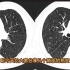 肺气肿CT病例分享，如何分型？放射科医生讲解！