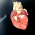 1分钟3d演示，心脏瓣膜置换术