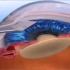 白内障手术过程，3D动画模拟演示。