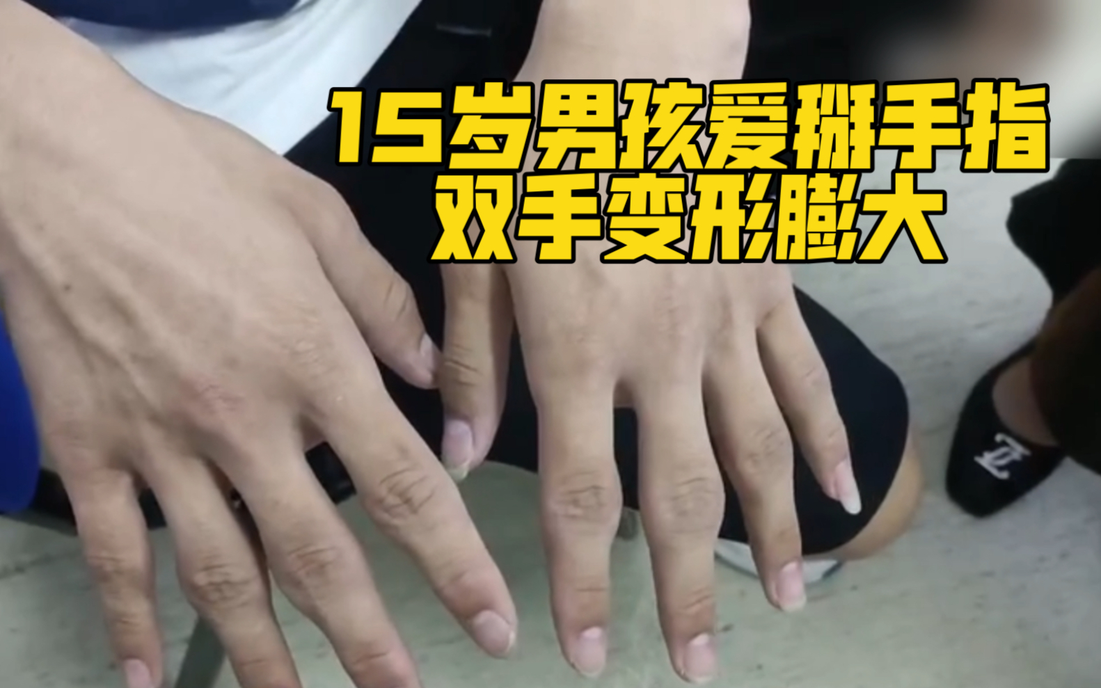 这个行为需当心！15岁男孩爱掰手指双手变形膨大