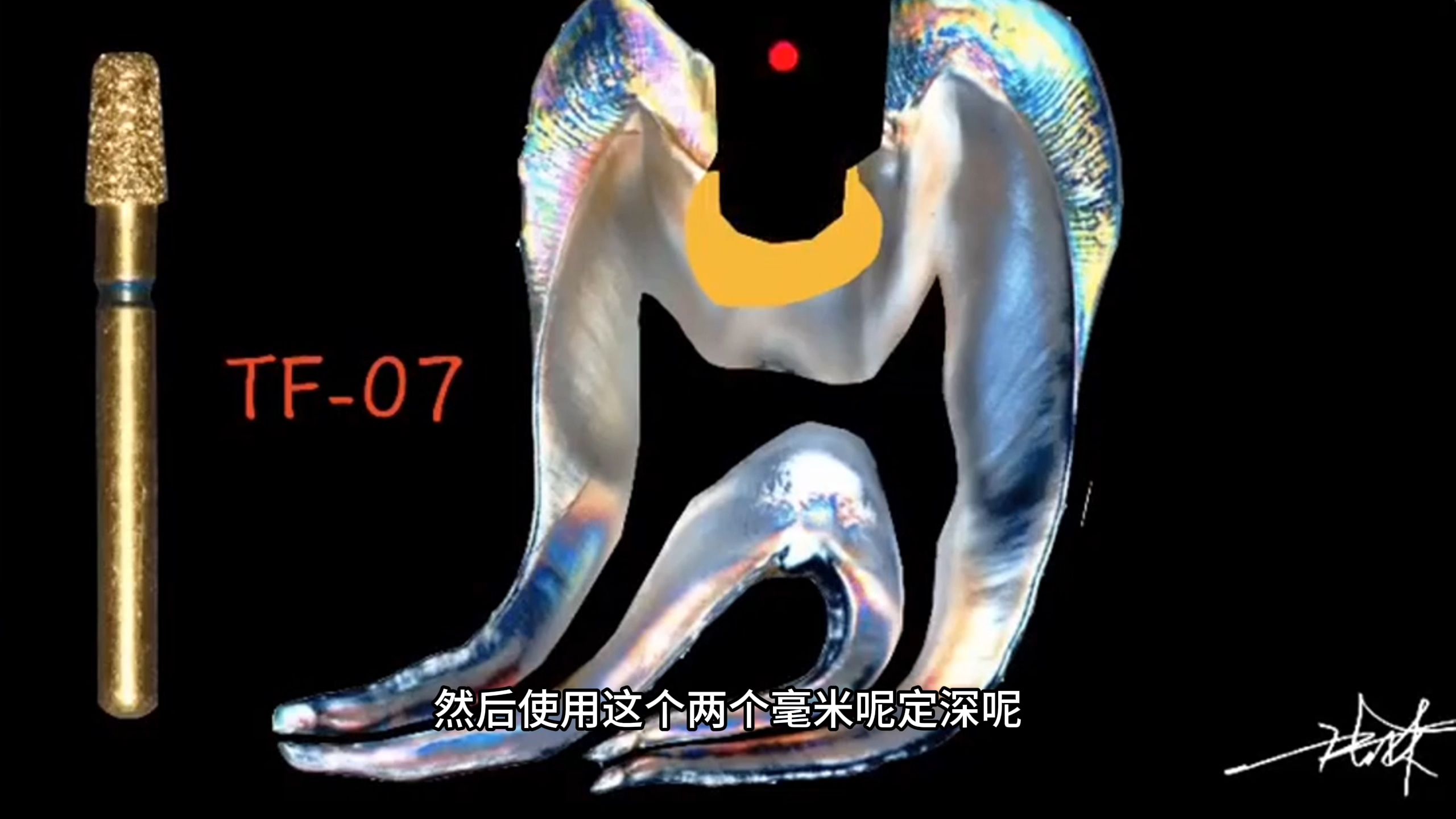 【张林】5天学会做嵌体2——嵌体预备+邻牙保护