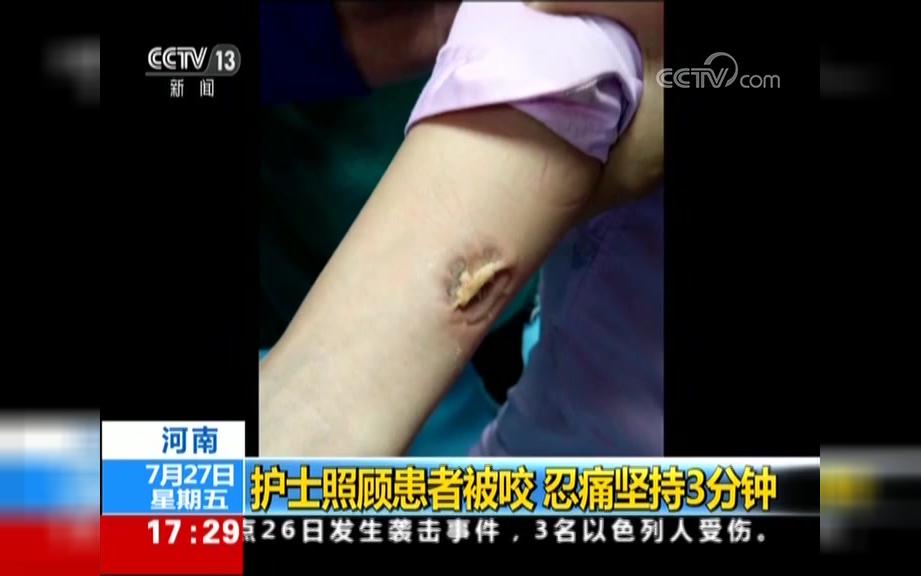 被病人突然咬住胳膊,她忍痛坚持了3分钟……