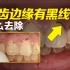 牙龈边上硬硬的黑线怎么回事？如何清理掉