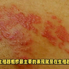 福州海福医院：生殖器疱疹有啥症状