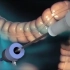 3D动画：腹腔镜阑尾切除术VS传统阑尾切除术