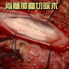 脊髓肿瘤切除术（非医学相关专业慎入