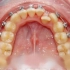 【强迫症舒服了】—记录牙齿矫正全过程
