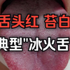 舌头红，舌苔白，典型的三焦不通，“冰火交融”舌象