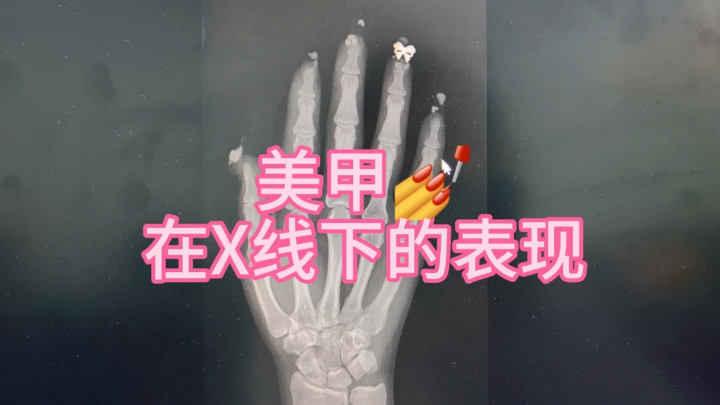 美甲，在X线下的表现！美甲的另一种方式也很美！