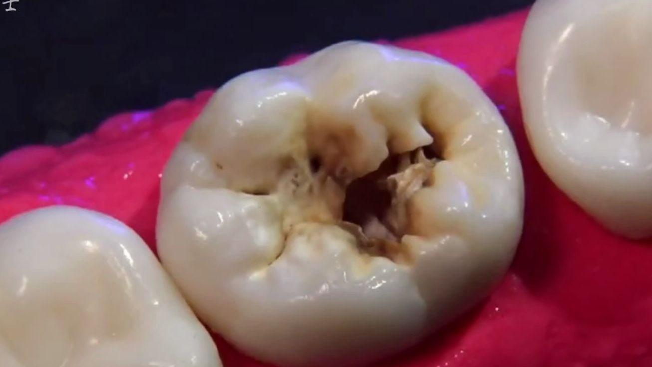 看看牙医是怎么修补一颗蛀牙的，补牙贵不是没有道理的！