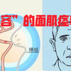 【周围神经病系列3】面肌痉挛