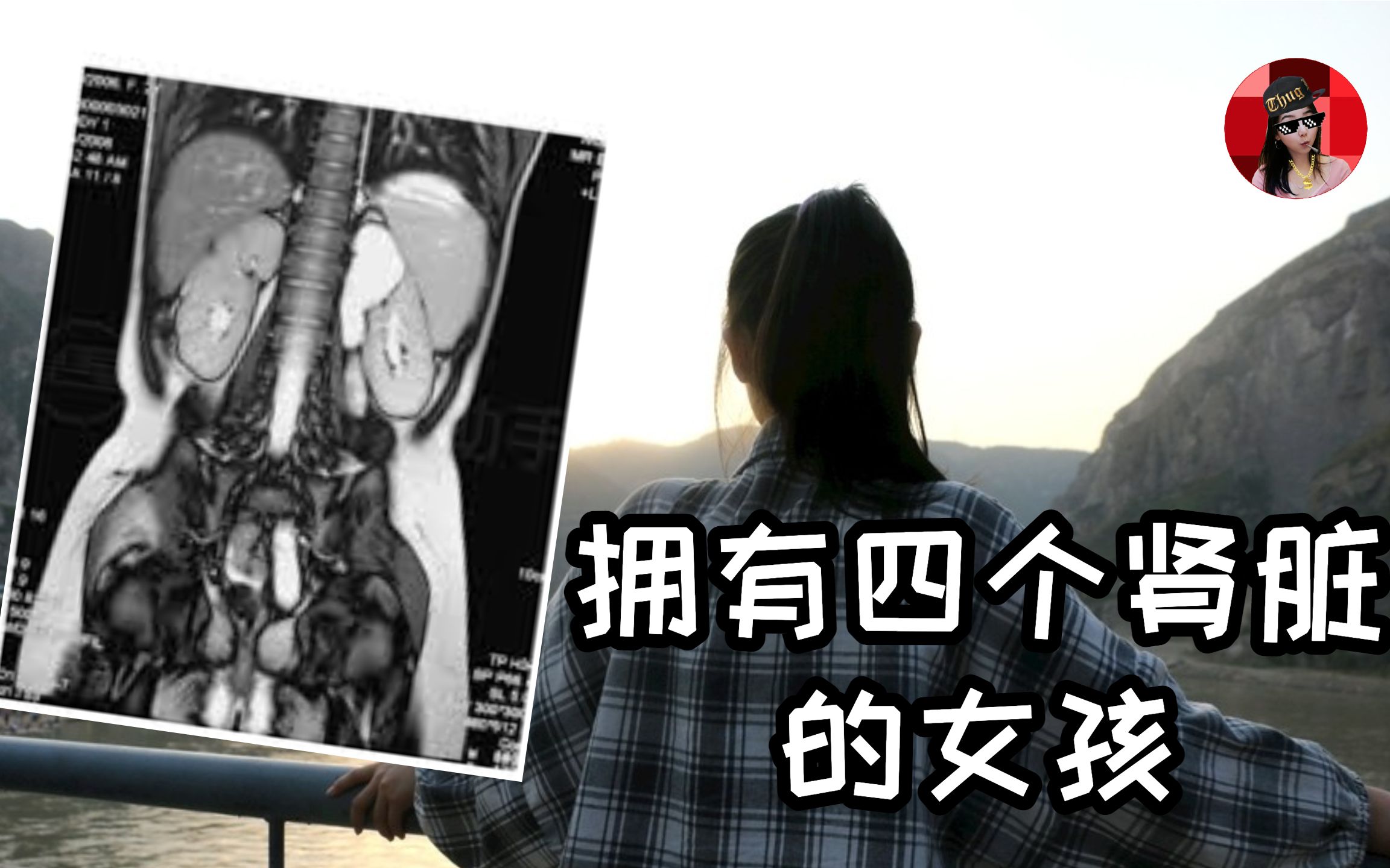 杭州女高中持续腰疼，检查发现竟然有四个肾？！