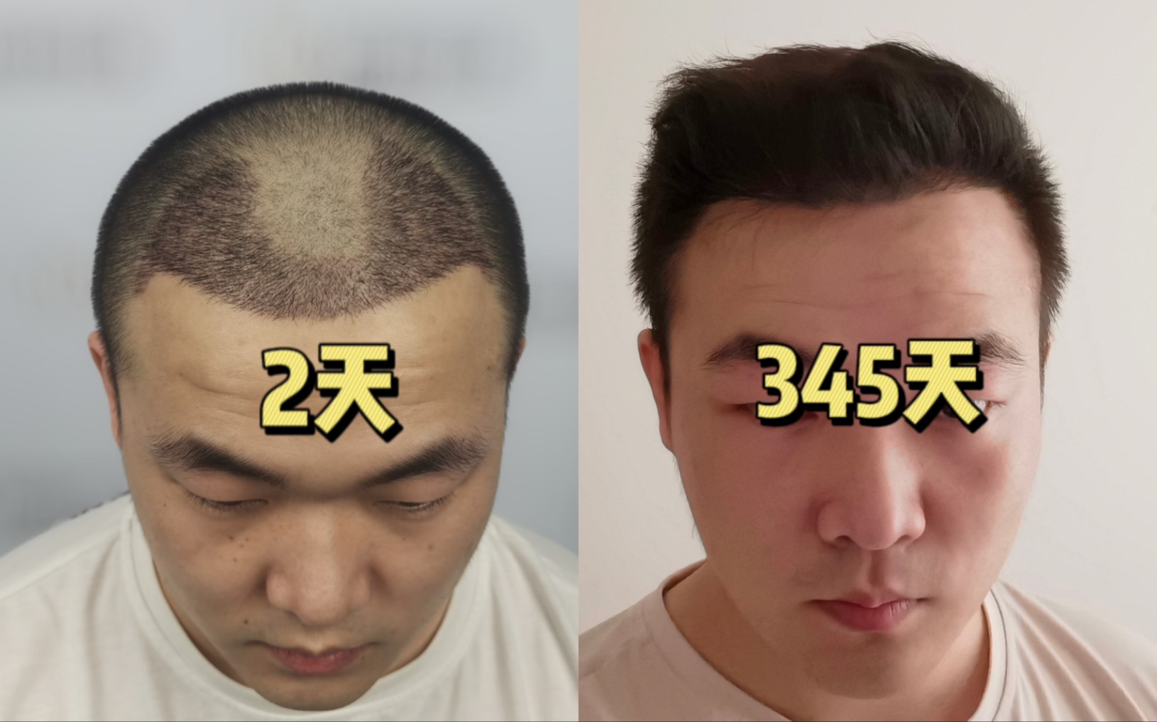 M型脱发植发345天真实分享，这算不算成功呢？