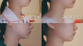 怎样瘦下巴和腮 1898dd6785b3754f5a684b3828664ef5b0db623c.jpg@280w_158h_1c_100q.jpg