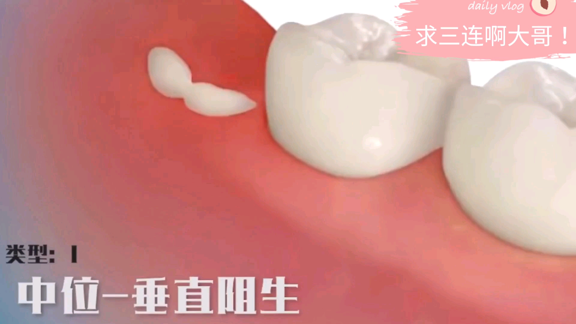 你会怎么看待：医学动画3D演示:常见几种拔智齿的过程，看着我都疼！[首次进行]的第1张示图