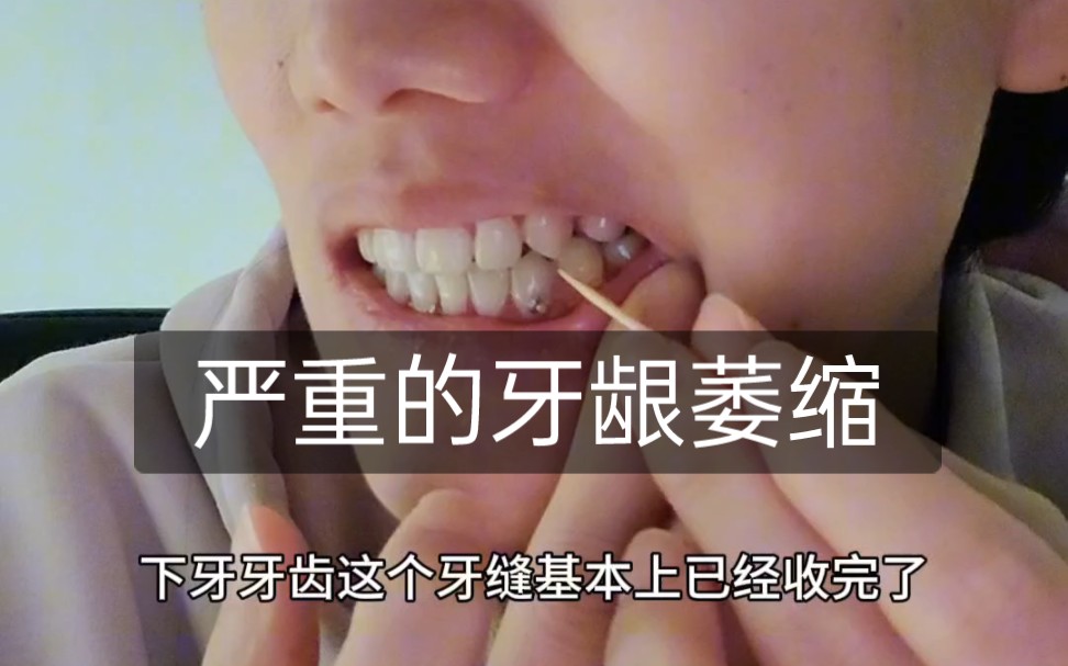 牙齿正畸舌侧矫正 | 10月上排牙齿收缝→正畸对牙齿伤害很大（）