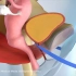 尿失禁：经闭孔尿道中段无张力悬吊术(TOT) | 医学动画 | 双语字幕 | 医学英语