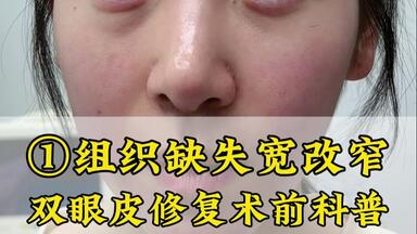 组织缺失宽改<em class="keyword">窄双眼皮修复</em>术前科普