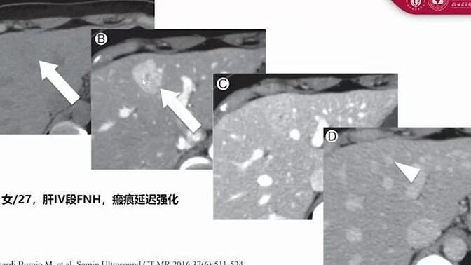 3.肝脏局灶性结节增生的影像诊断-肝脏常见肿瘤及肿瘤样病变影像诊断系列