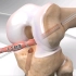 罗纳尔多经历的手术，前交叉韧带修复手术过程，3D演示。。