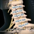 高风险手术，颈部椎管狭窄减压术，3D演示。。