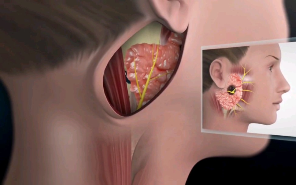 腮腺肿瘤切除手术过程，3D演示。。