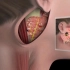 腮腺肿瘤切除手术过程，3D演示。。