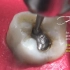 去除银汞合金，银汞合金可以补牙？