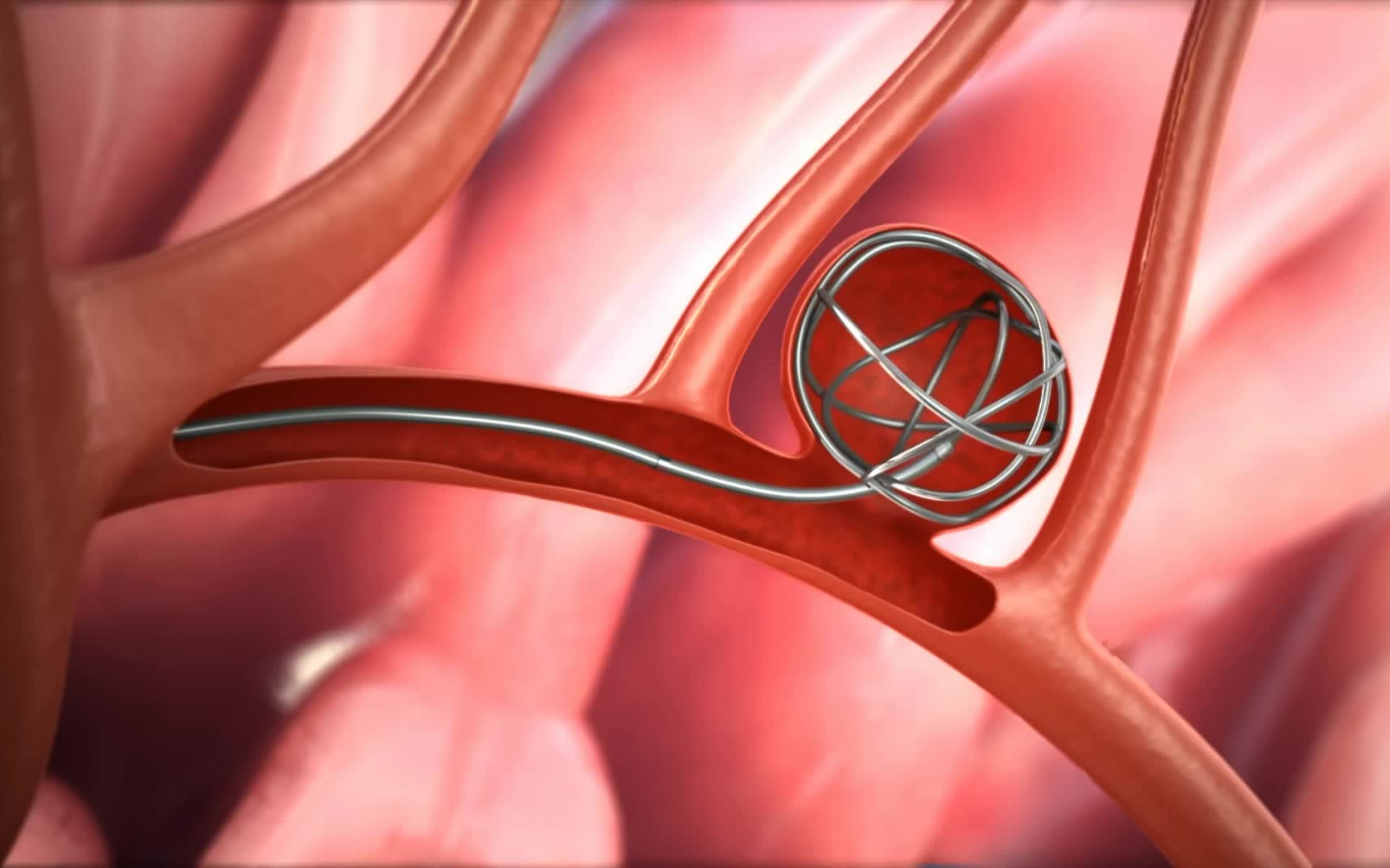 【3d医学动画】脑动脉瘤介入治疗