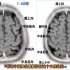 影像解剖：颅脑中央沟断层图像如何识别？放射科医生讲解！