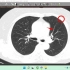 CT入门教学（11）：胸部CT怎么看？