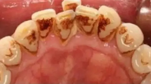 紧急曝光：如何快去除牙结石还不反复？这些方法一定不能错过！