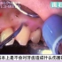 日本患者因为牙周病去看牙，医生无力回天只能洗牙后拔除