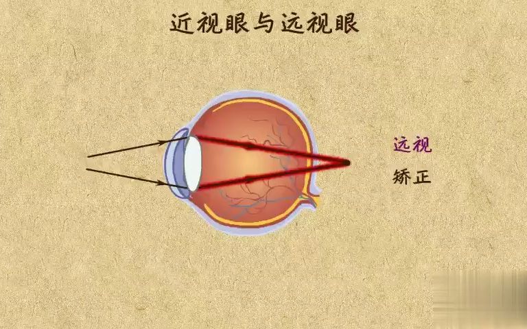 14. 近视眼与远视眼
