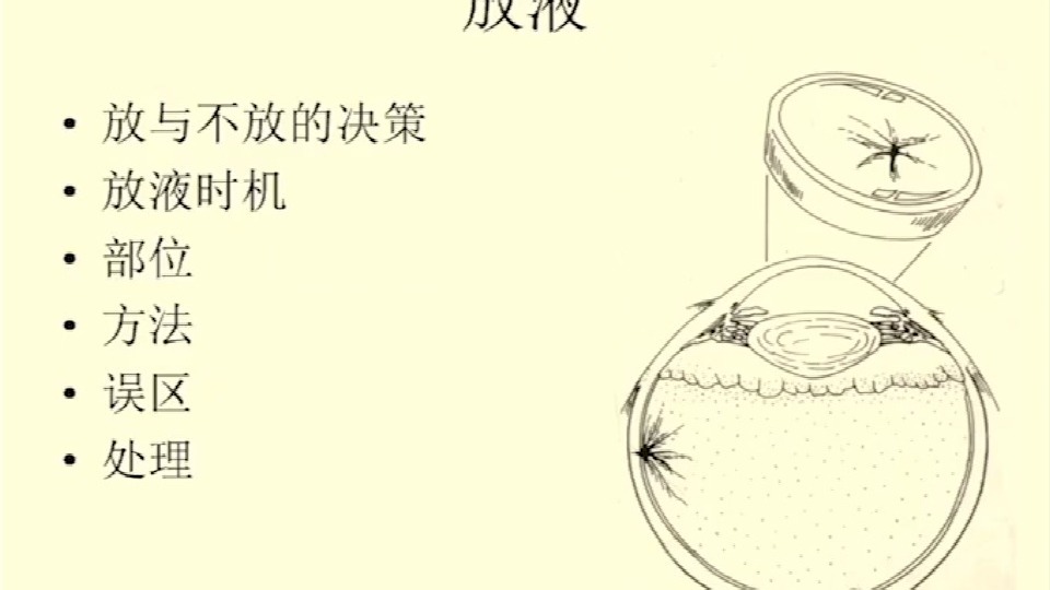 眼科专家魏文斌教授讲解《巩膜扣带手术技巧》